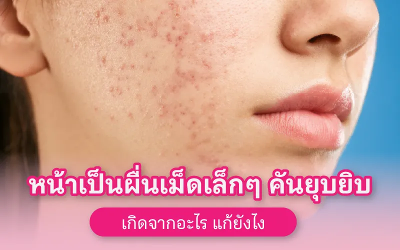 หน้าเป็นผื่นเม็ดเล็กๆ คันยุบยิบ เกิดจากอะไร แก้ยังไง